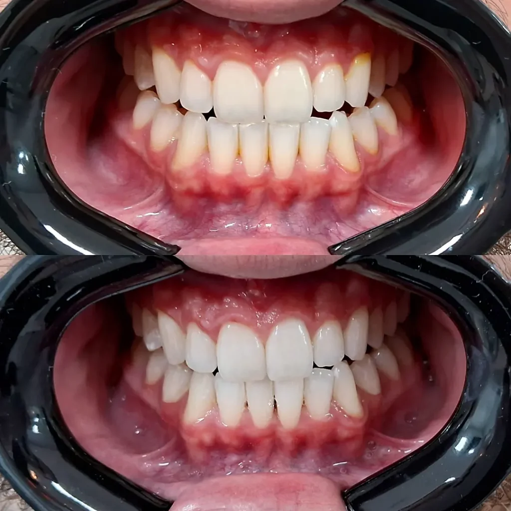 Clareamento dental em Balneário Camboriú
