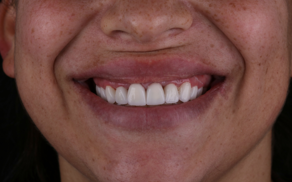 Antes e depois de facetas de porcelana em Balneário Camboriú, caso real da Ocean Odontologia