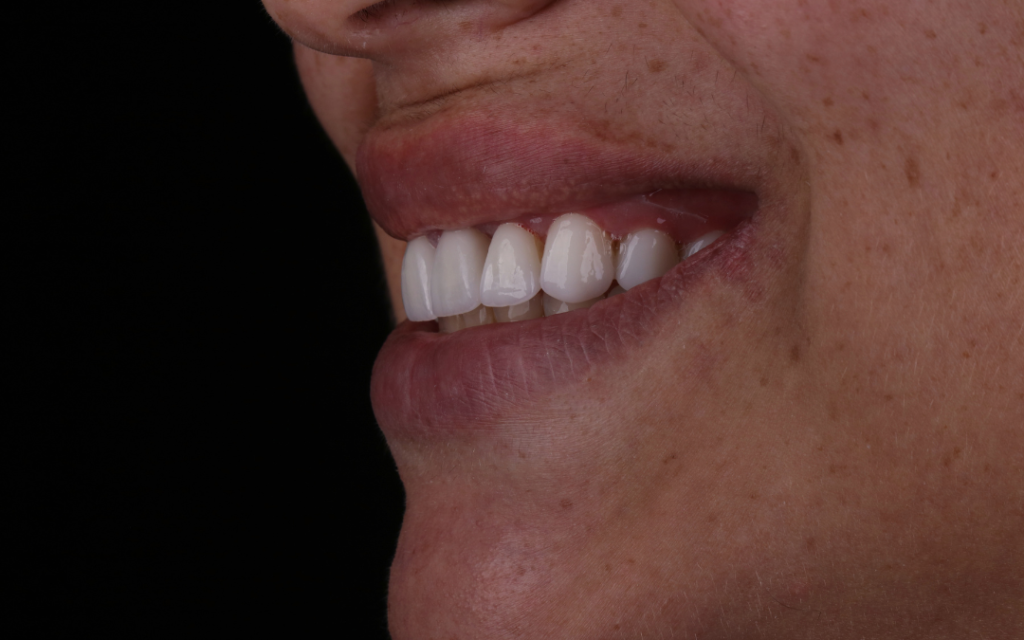 Antes e depois de facetas de porcelana em Balneário Camboriú, caso real da Ocean Odontologia