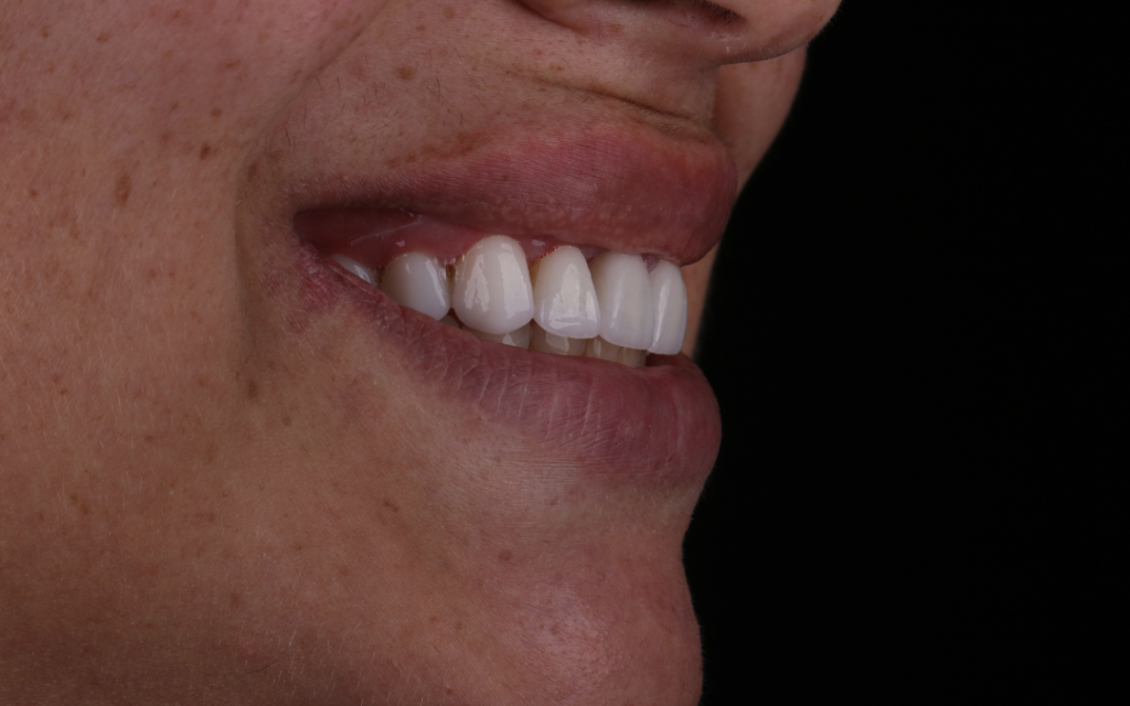 Antes e depois de facetas de porcelana em Balneário Camboriú, caso real da Ocean Odontologia