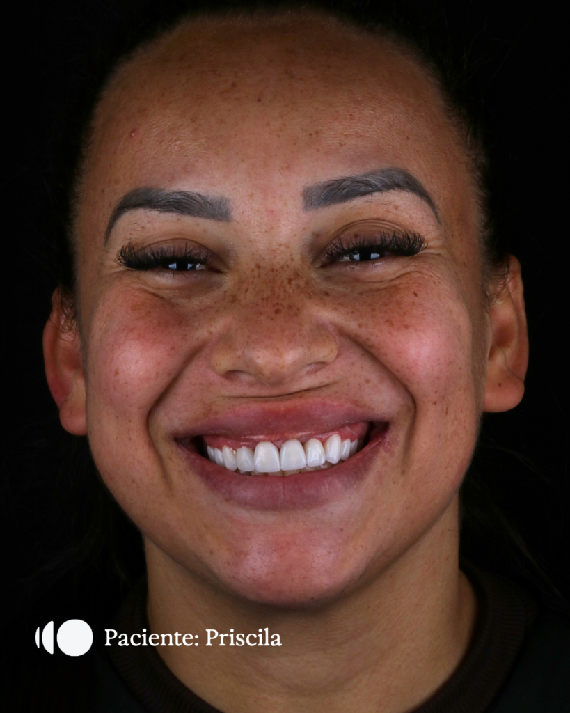 Caso real de Facetas de Porcelana em Balneário Camboriú